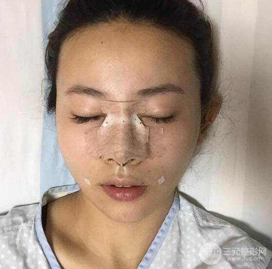 珠海陸達(dá)彭劍隆鼻整形術(shù)前術(shù)后對比