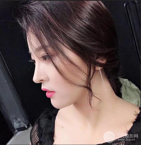 珠海陸達(dá)彭劍隆鼻整形術(shù)前術(shù)后對比