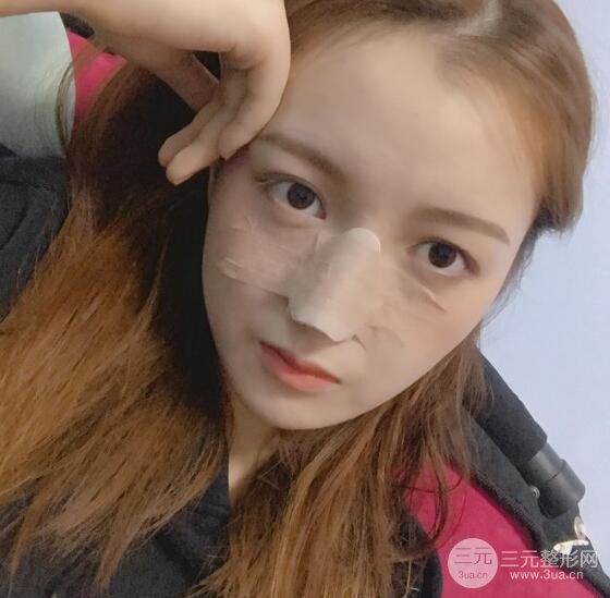 隆鼻整形多久恢復(fù)自然，模特公布隆鼻整形恢復(fù)記錄附照片