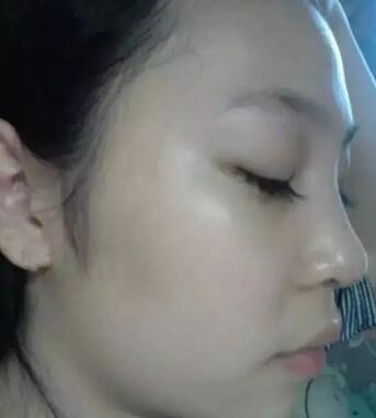 我的假體隆鼻恢復(fù)過程,有圖有真相哦~