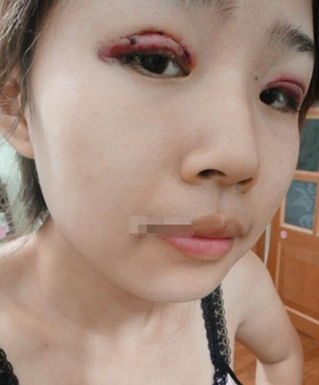 你們來看看藝美門智和做的埋線雙眼皮，瞬間變大眼美女