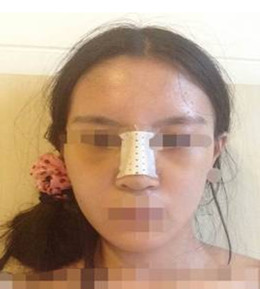 藝美門智和綜合隆鼻，你值得擁有
