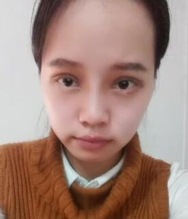全切雙眼皮+去脂肪，終于擺脫小眼睛了