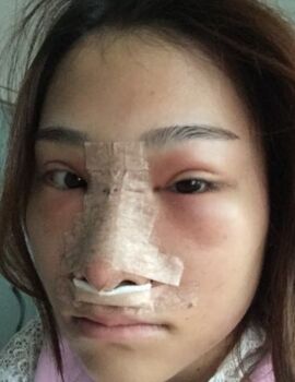 硅膠隆鼻還墊鼻尖了，甘泉涌做的果真的很好喲