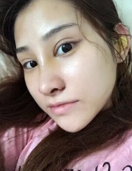 硅膠隆鼻還墊鼻尖了，甘泉涌做的果真的很好喲