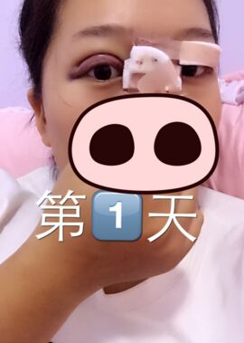 終于把雙眼皮割了，無錫菲尚張樹功做的