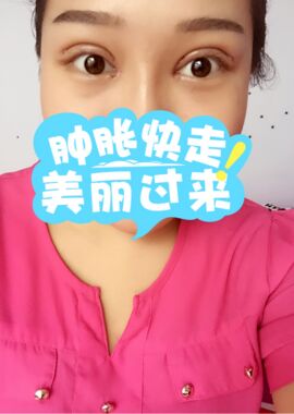 終于把雙眼皮割了，無錫菲尚張樹功做的