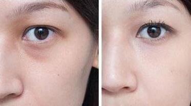 去眼袋有的方法，超聲波去眼袋前后對比圖