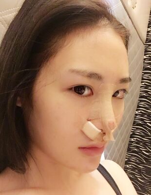 在隆鼻整形之后終于有了超精致的鼻子，尹度龍做的喲