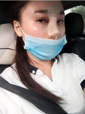 膨體隆鼻改變了我的塌鼻子，整體都精致不少