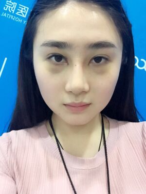 膨體隆鼻改變了我的塌鼻子，整體都精致不少