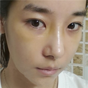 廣州博仕做了隆鼻整形半年了，分享恢復(fù)過程和前后對(duì)比果照片哦~