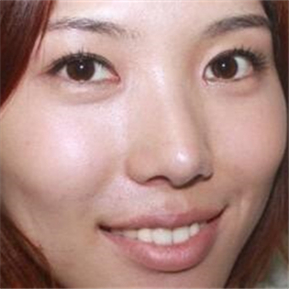 武漢希思特做了埋線法雙眼皮、開內(nèi)眼角和鼻尖移植軟骨整形手術(shù)~