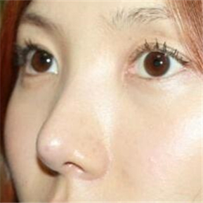 武漢希思特做了埋線法雙眼皮、開內(nèi)眼角和鼻尖移植軟骨整形手術(shù)~