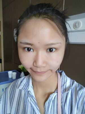 自體脂肪面部填充后恢復(fù)，成活率還蠻高的