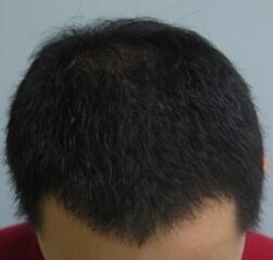 植發(fā)4個(gè)月了,期間有正常脫發(fā)