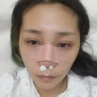 做鼻部綜合整形真是一件正確的決定，鼻子恢復(fù)過程分享