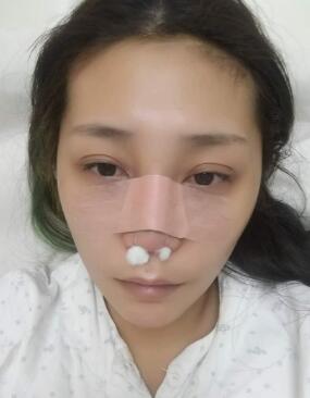 鼻部綜合整形手術