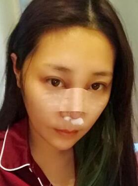 隆鼻整形手術第二天的照片