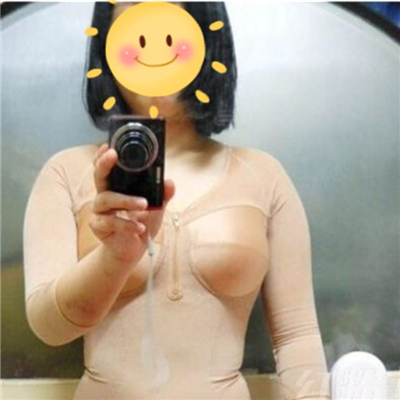 腰腹部吸脂減肥手術恢復過程和前后對比果圖片分享~