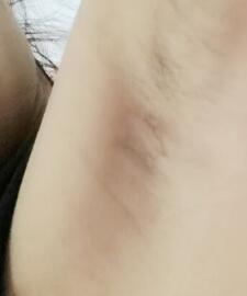 假體隆胸快術后兩個月了，腋下傷口已經完全愈合
