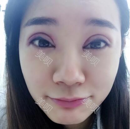 埋線雙眼皮我從內(nèi)雙的小眼睛變成大眼睛電眼了