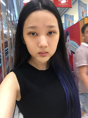 切開雙眼皮+假體隆下巴，我不再是典型的路人甲