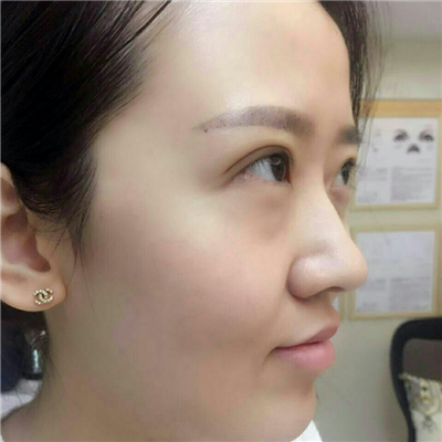 光子嫩膚快一個(gè)月了，分享手術(shù)過程和前后對比果圖片哦~