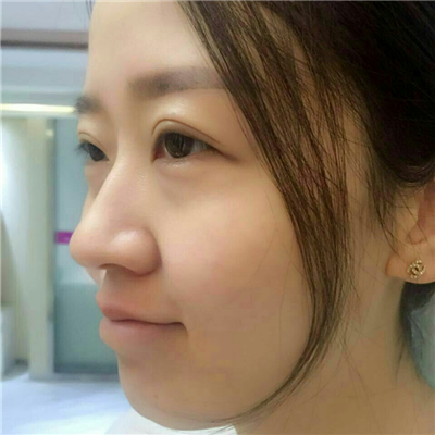 光子嫩膚快一個(gè)月了，分享手術(shù)過程和前后對比果圖片哦~