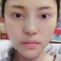 假體隆鼻15天后恢復(fù)圖，隆鼻果自然