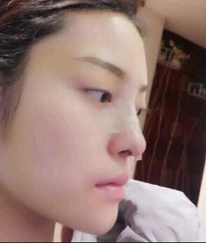 假體隆鼻15天后恢復(fù)圖,隆鼻果自然