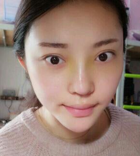 假體隆鼻15天后恢復(fù)圖,隆鼻果自然