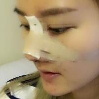 硅膠假體隆鼻過程和隆鼻前后圖片，真實(shí)案例分享