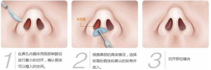 硅膠假體隆鼻過(guò)程和隆鼻前后圖片,真實(shí)案例分享