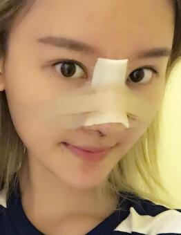 硅膠假體隆鼻過(guò)程和隆鼻前后圖片,真實(shí)案例分享