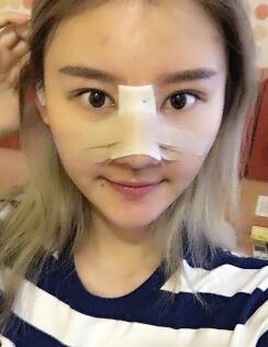 硅膠假體隆鼻過(guò)程和隆鼻前后圖片,真實(shí)案例分享