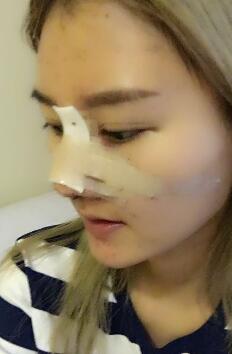 硅膠假體隆鼻過(guò)程和隆鼻前后圖片,真實(shí)案例分享