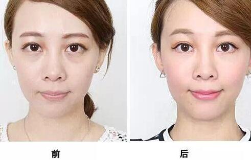 超聲波去眼袋