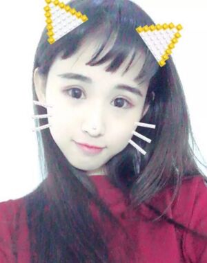 三點(diǎn)定位雙眼皮恢復(fù)實(shí)例，張永義做的