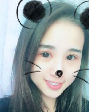 三點(diǎn)定位雙眼皮恢復(fù)實(shí)例，張永義做的
