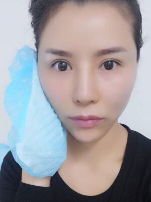 臉部埋埋蛋白線.提升果圖，真實經(jīng)歷分享