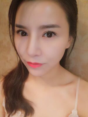臉部埋埋蛋白線.提升果圖，真實經(jīng)歷分享