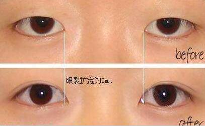 開(kāi)眼角+割雙眼皮，眼睛整形價(jià)格表曝光