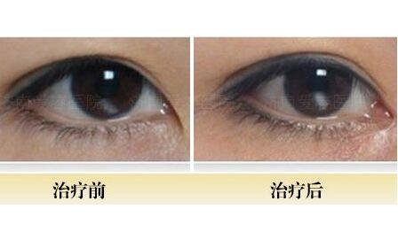 開(kāi)內(nèi)眼角前后對(duì)比圖，眼睛整形價(jià)格