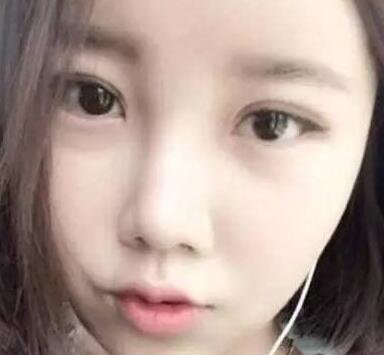 雙眼皮整形前后對(duì)比圖,單眼皮變雙眼皮整容日記