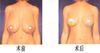 巨大乳房縮小術(shù)成好嗎?手術(shù)前后對比圖