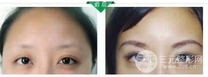 眉毛種植術(shù)的成好嗎?