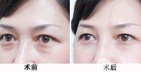 怎樣去除下眼袋?去眼袋手術(shù)后六天照片