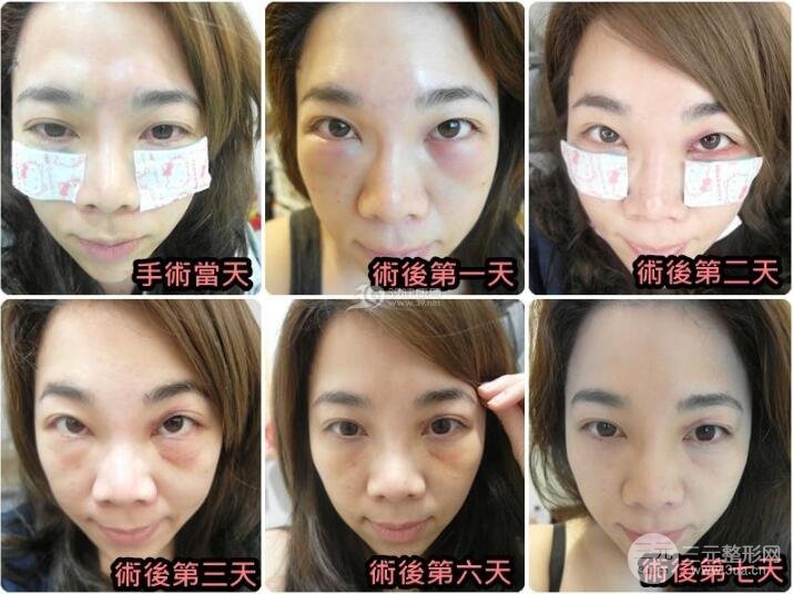 怎樣去除下眼袋?去眼袋手術(shù)后六天照片