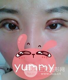北京全切雙眼皮手術(shù)真實(shí)案例，果對比圖